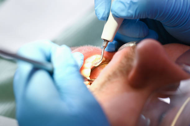 Best Urgent Care for Lost Fillings or Crowns in Griffith, IN